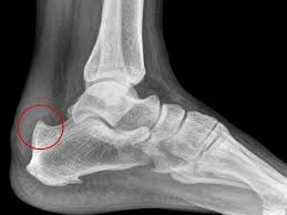 radiografia hallux rigidus