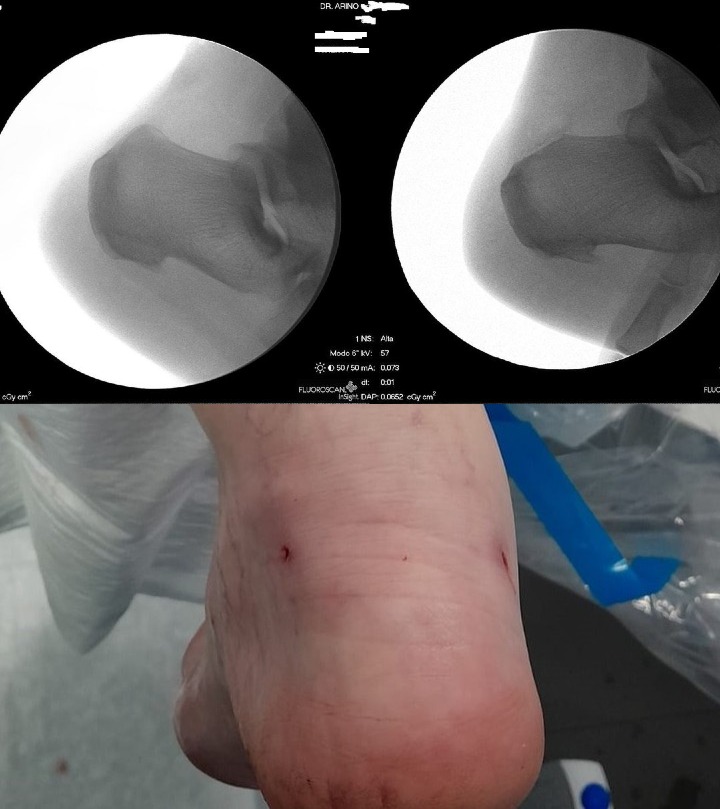 radiografia hallux rigidus