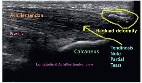 radiografia hallux rigidus