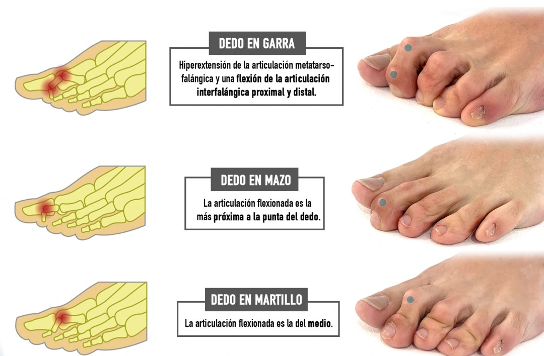 radiografia hallux rigidus
