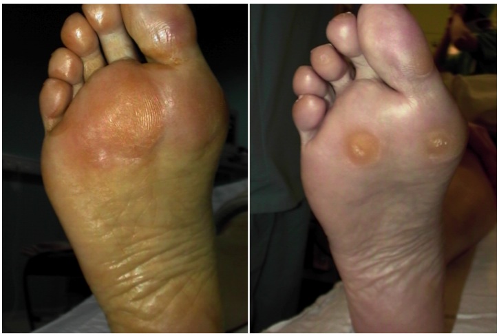radiografia hallux rigidus