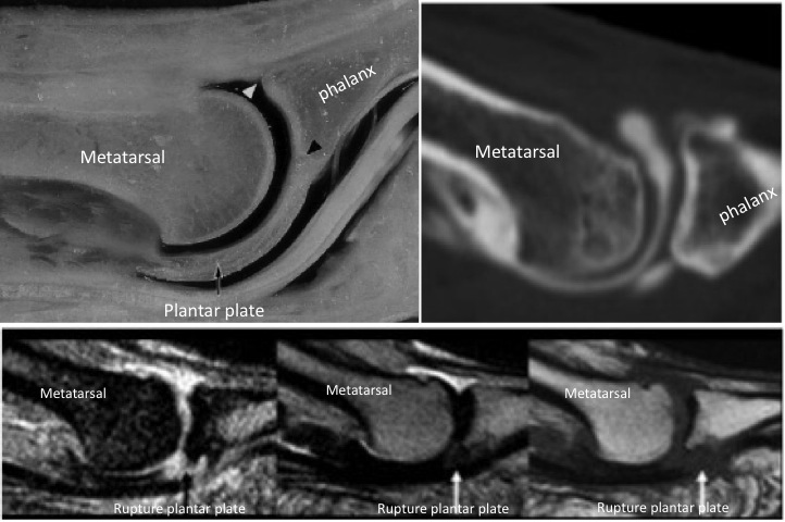 radiografia hallux rigidus