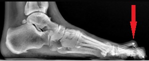 radiografia hallux rigidus