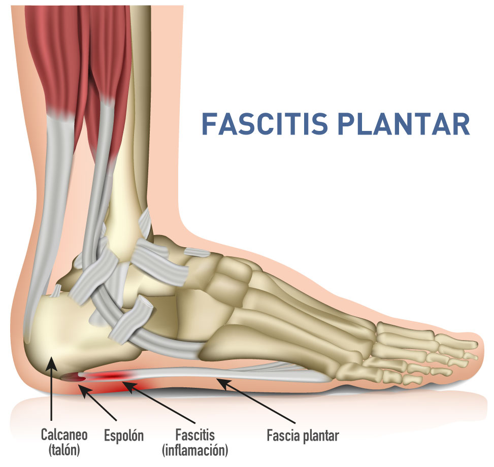 fascitis plantar