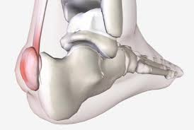 radiografia hallux rigidus