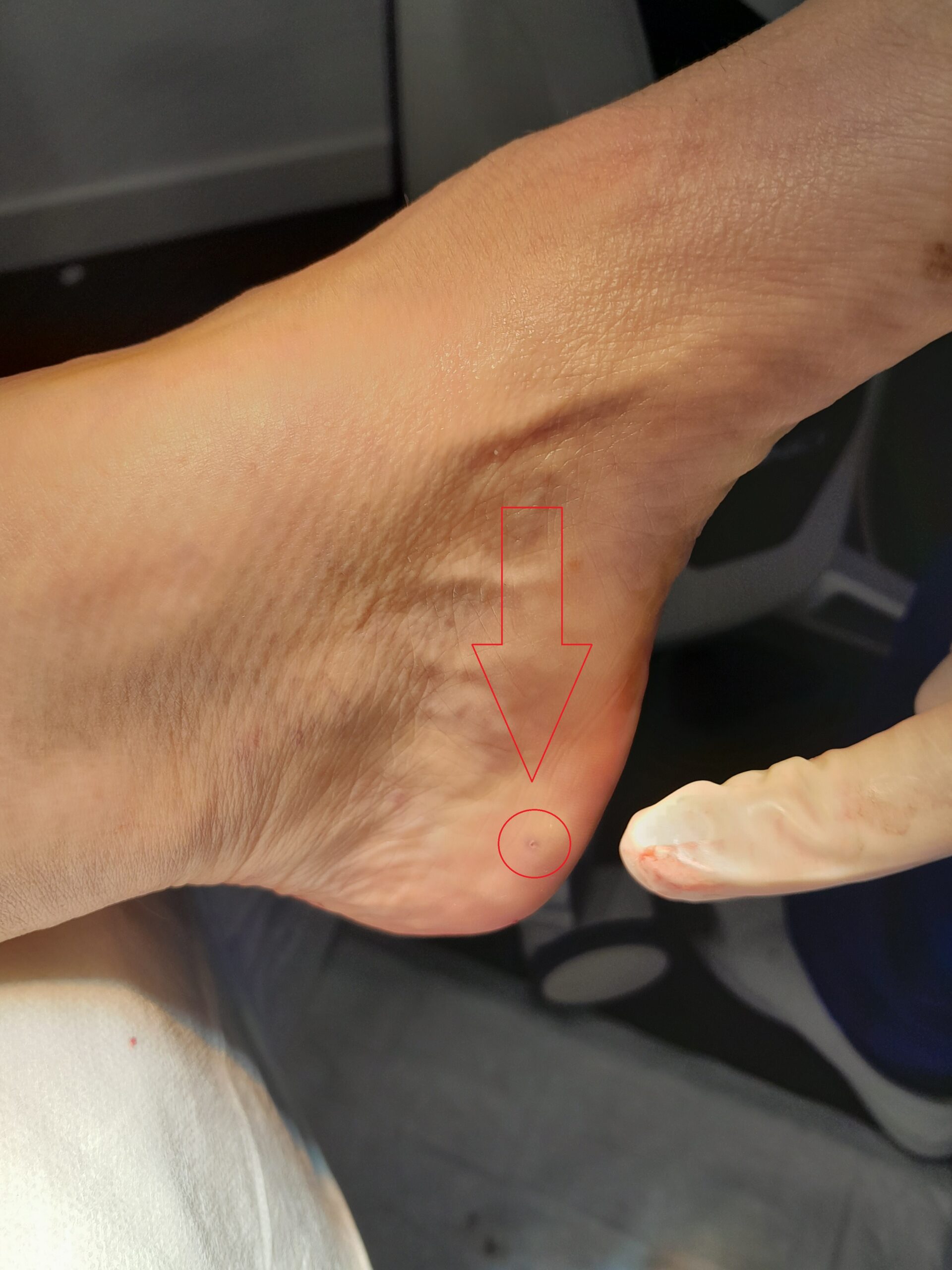 postoperatorio fascitis plantar y espolon
