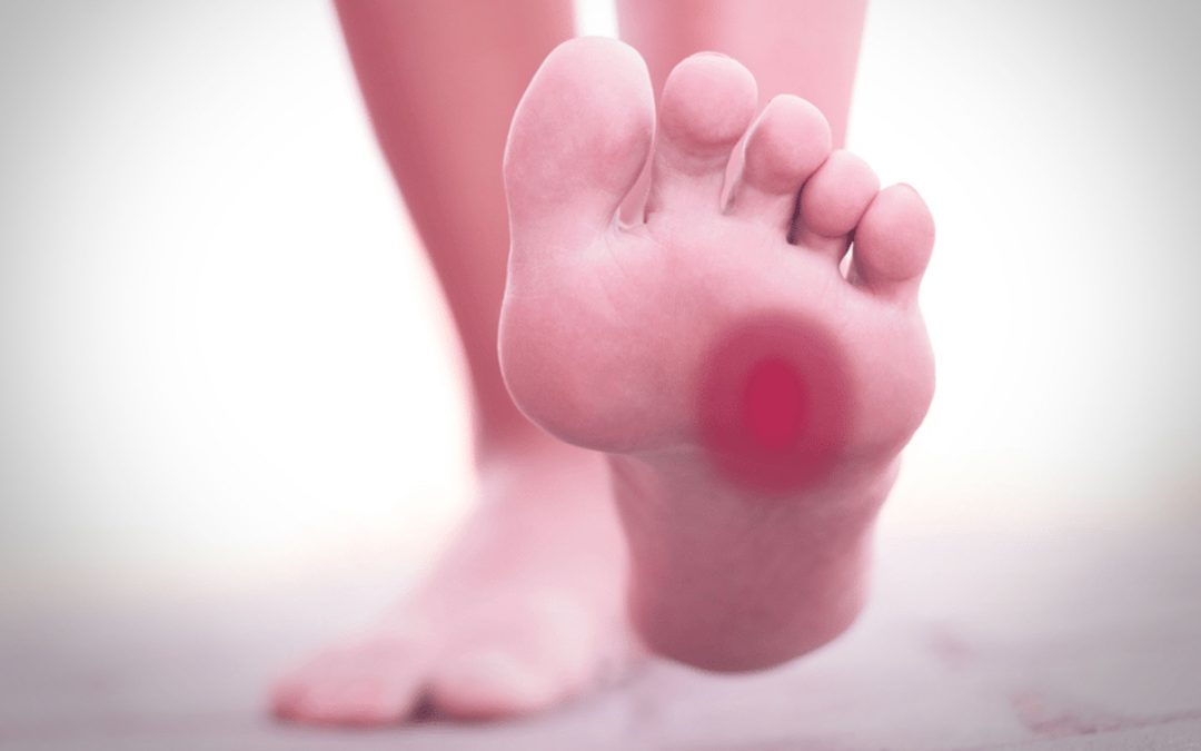 causas neuroma de morton