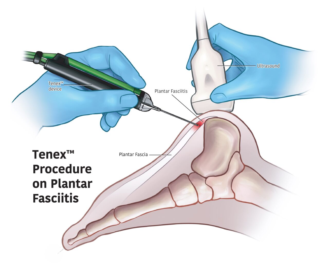 fascitis plantar tenex